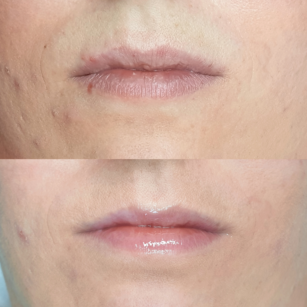 Hydra Glow Lips Studio Landi Barcelona