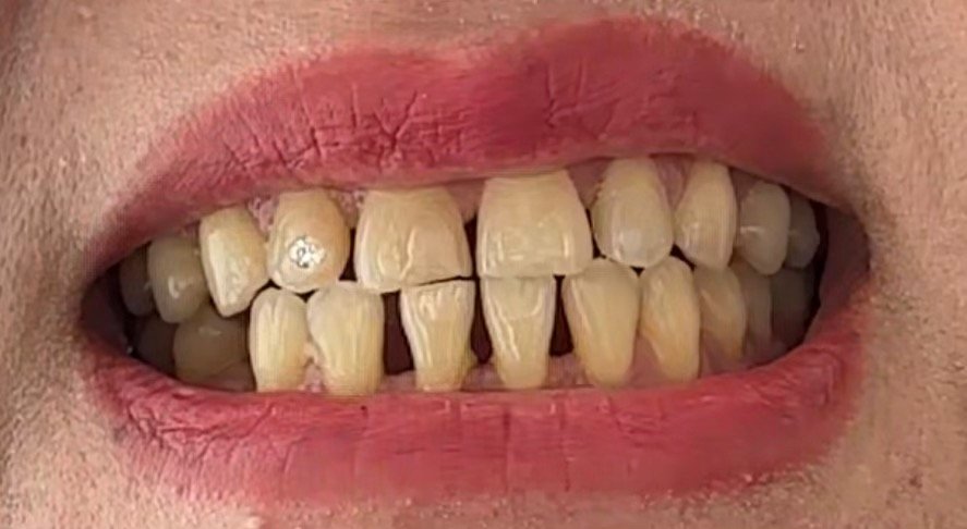 Before - Full mouth restoration with custom crowns for enhanced function and aesthetics, crafted by CeraForm Dental Services for a perfect fit and long-lasting results.