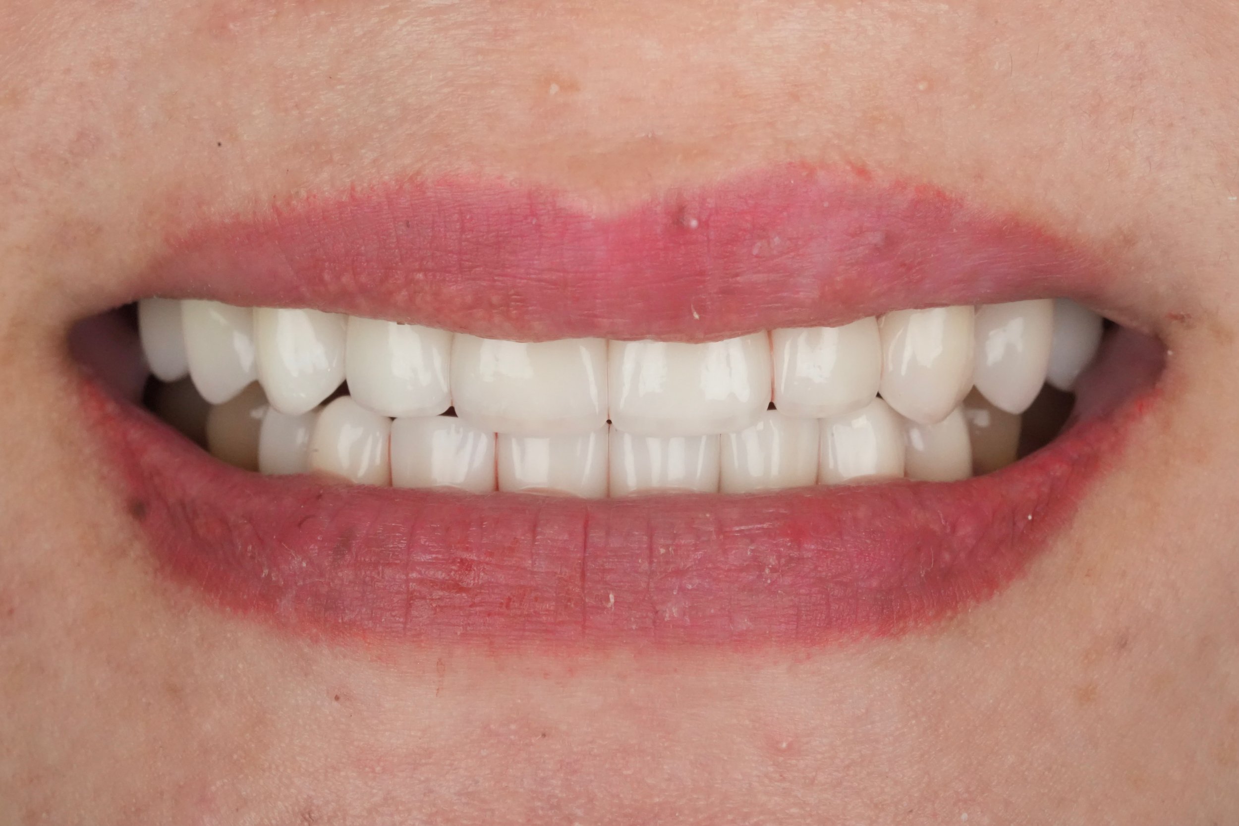 After - Full mouth restoration with custom crowns for enhanced function and aesthetics, crafted by CeraForm Dental Services for a perfect fit and long-lasting results.
