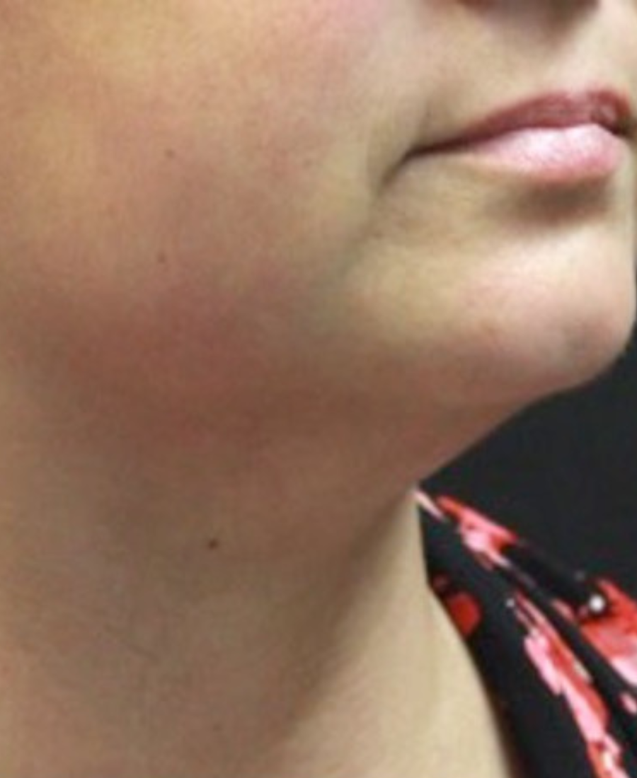 After treatment - Submental Contouring