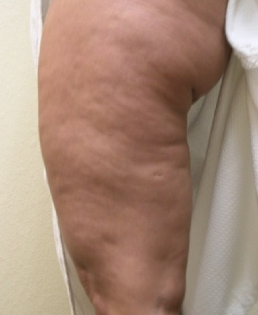 Before treatment - Body Textural Improvement