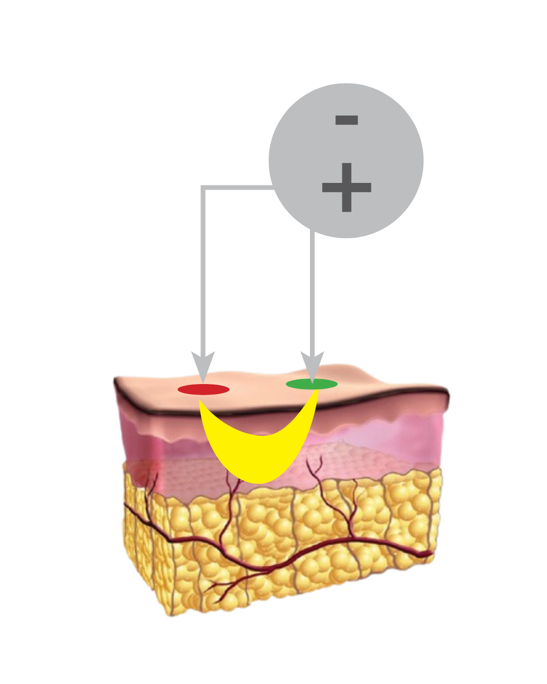 Bipolar RF diagram