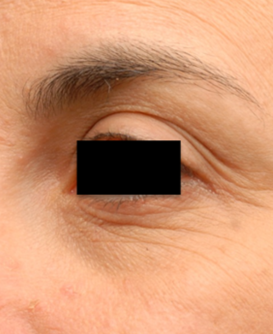 Before treatment - Eye & Perioral