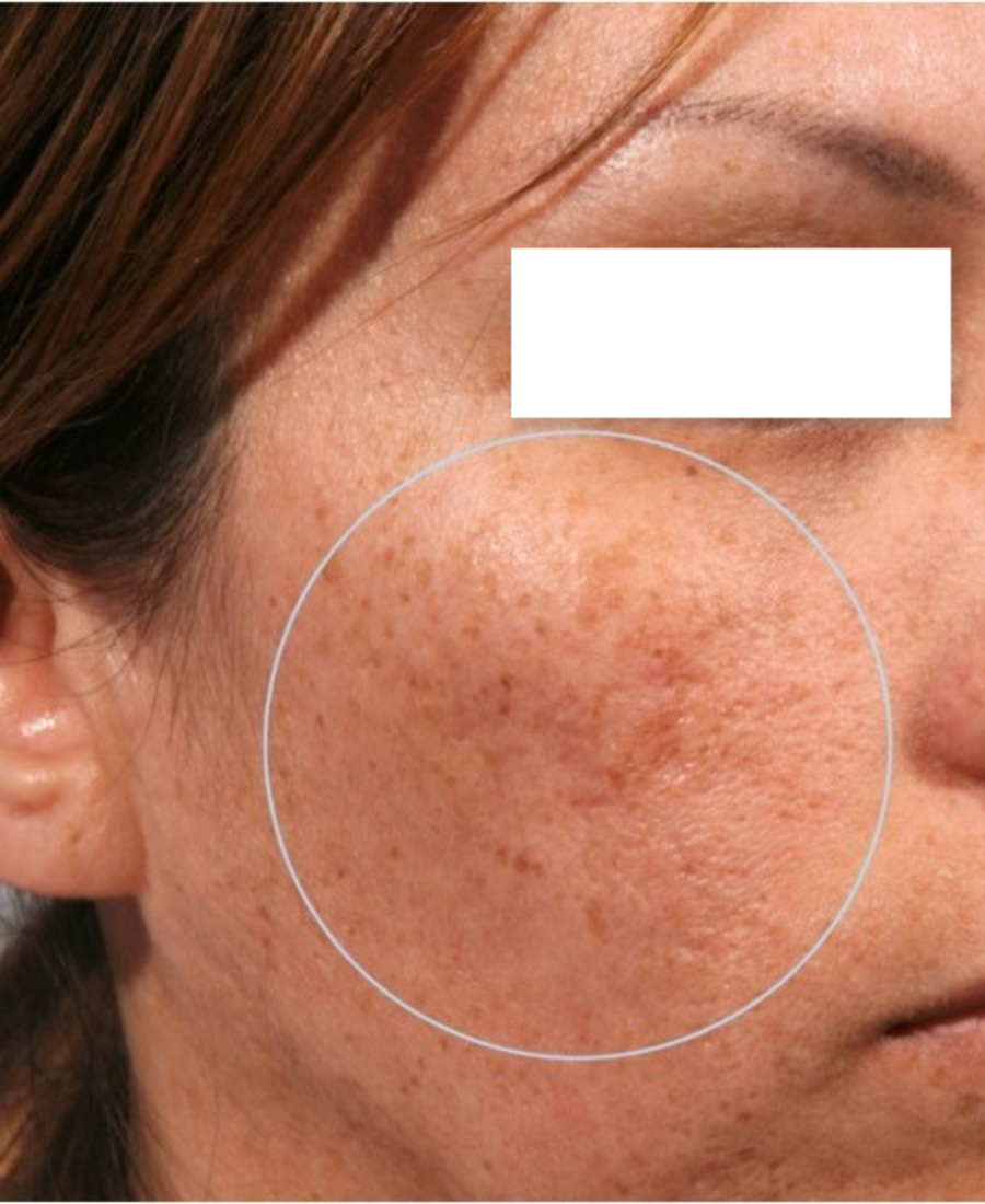 After treatment - Acne Scar