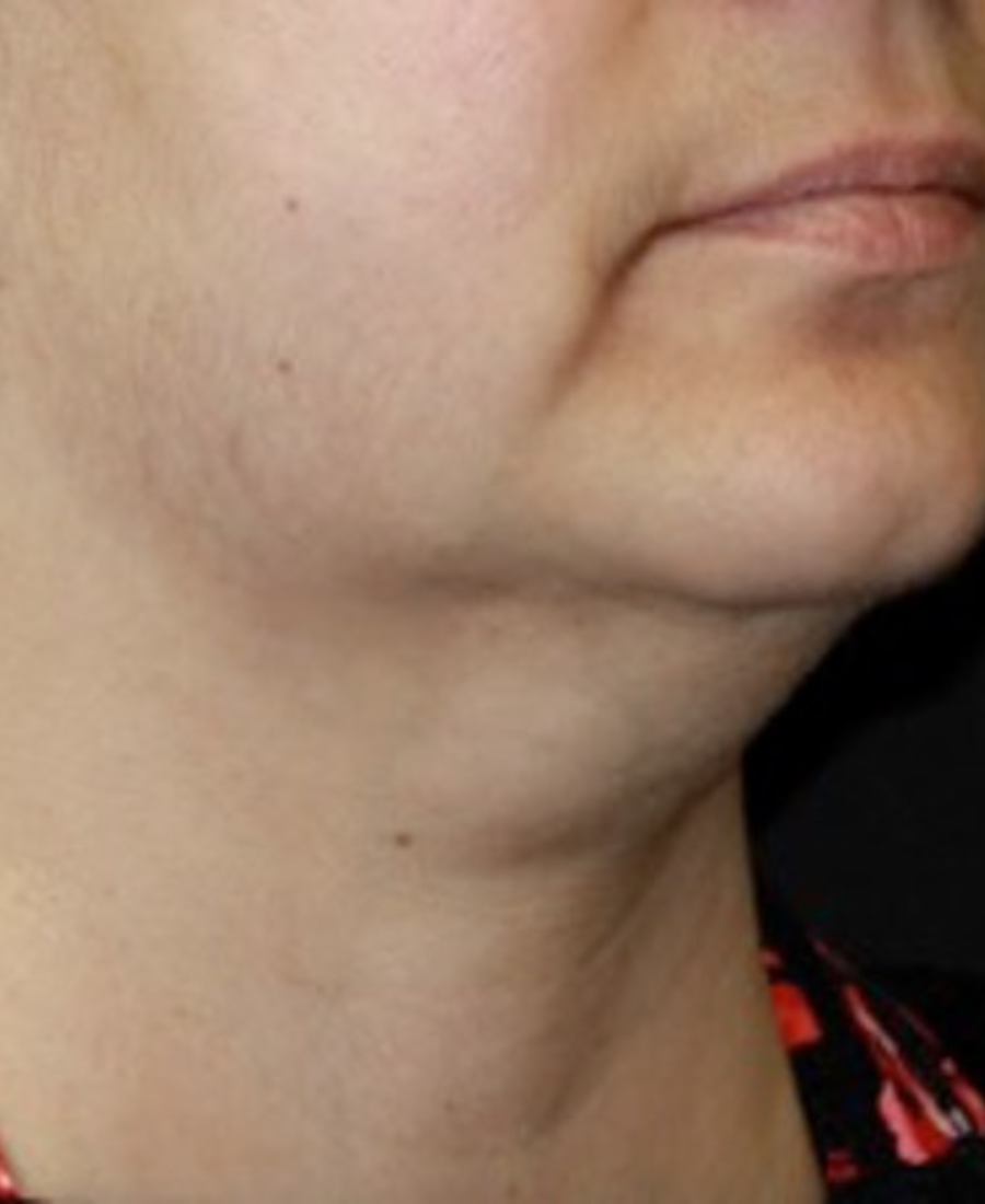 Before treatment - Submental Contouring