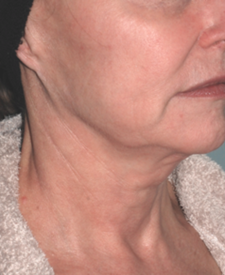 After treatment - Facial Lifting & Contouring