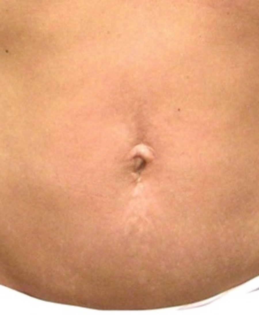 After treatment - Body Tightening