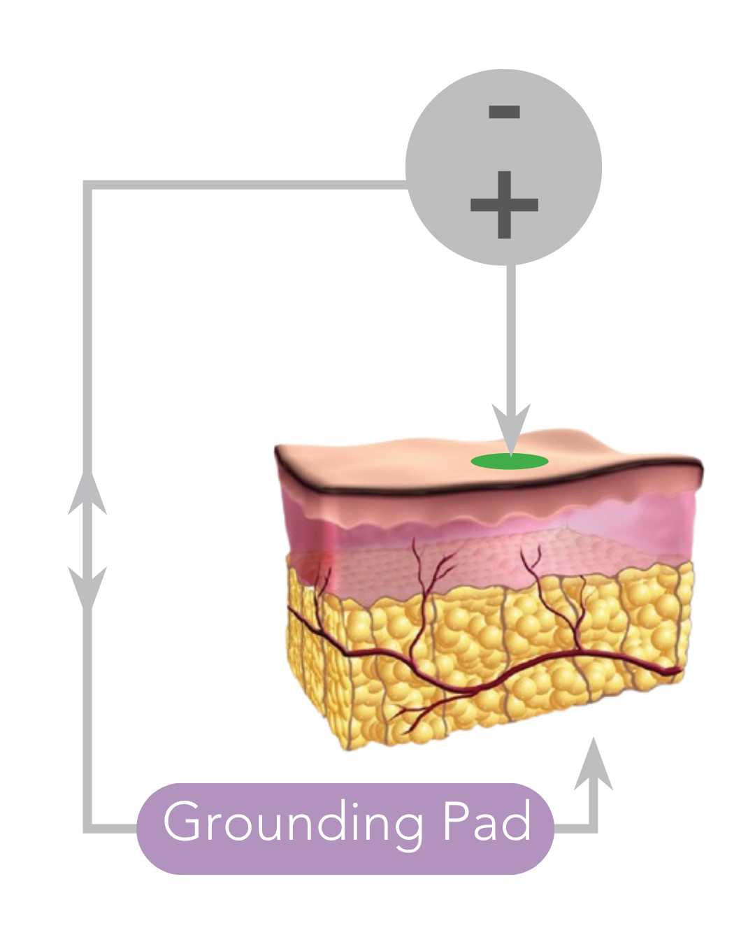 Monopolar RF diagram
