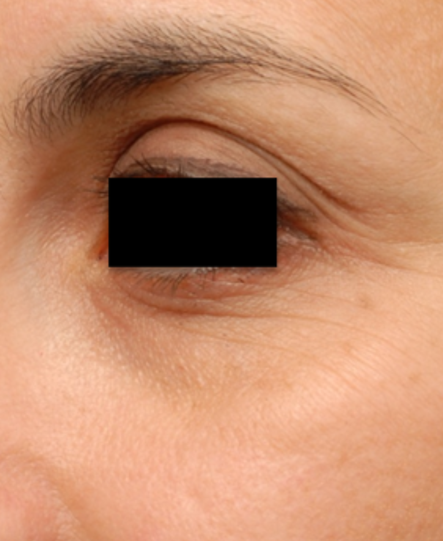After treatment - Eye & Perioral