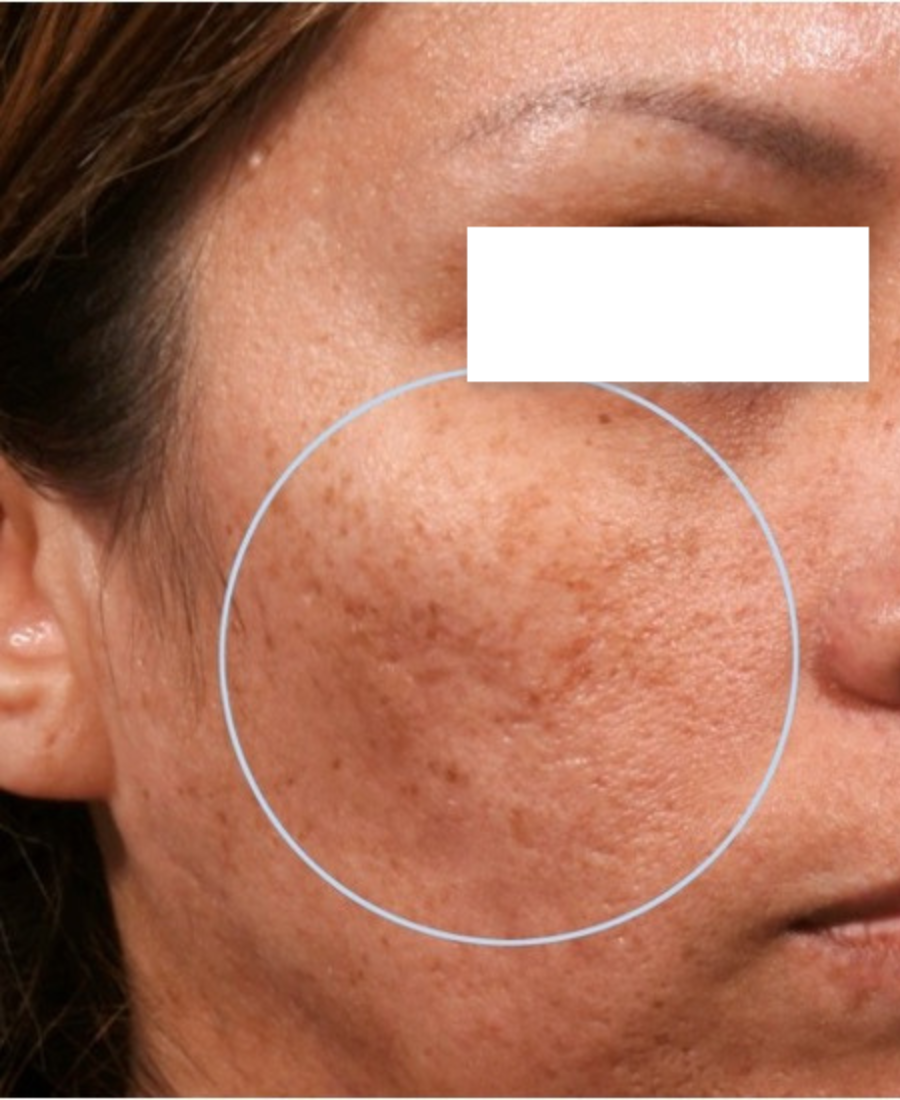 Before treatment - Acne Scar