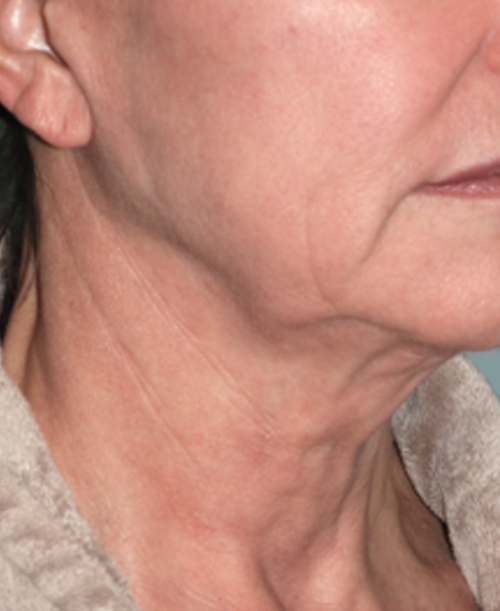 Before facial lifting