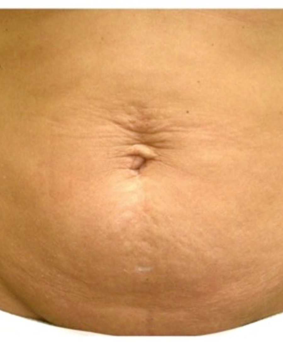 Before treatment - Body Tightening
