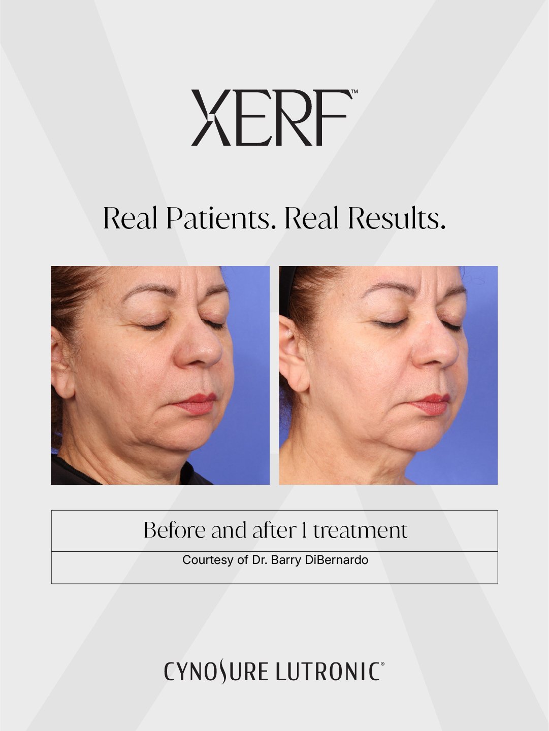 Before & After - Lip Filler