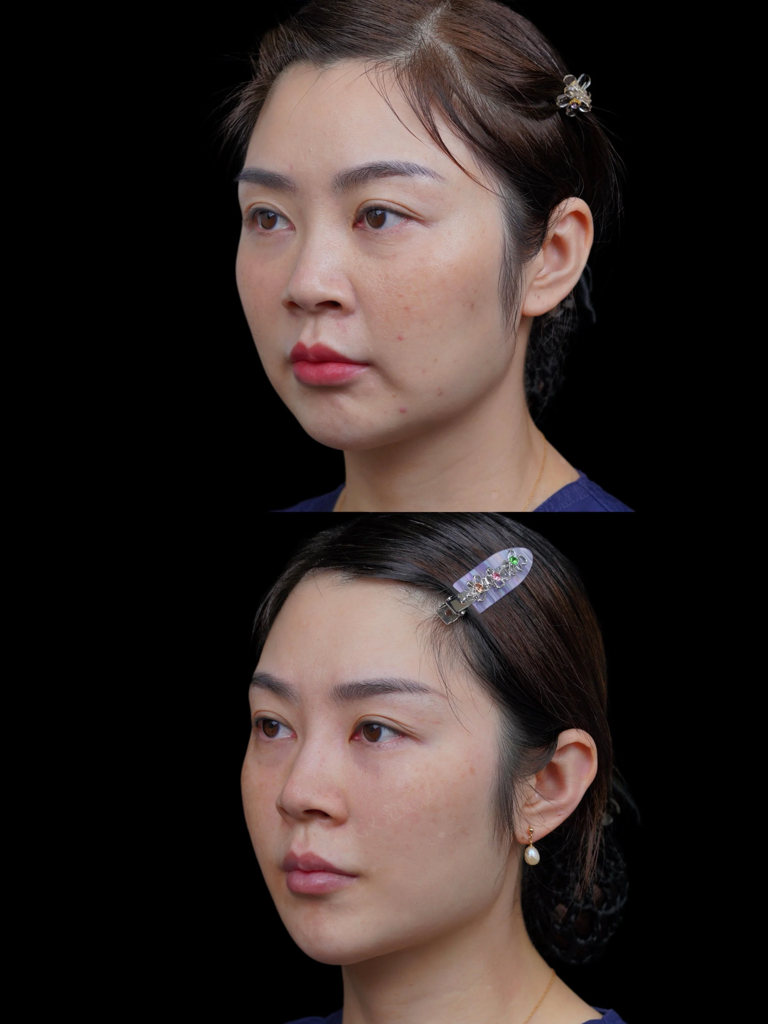 Before & After - Forehead Lines