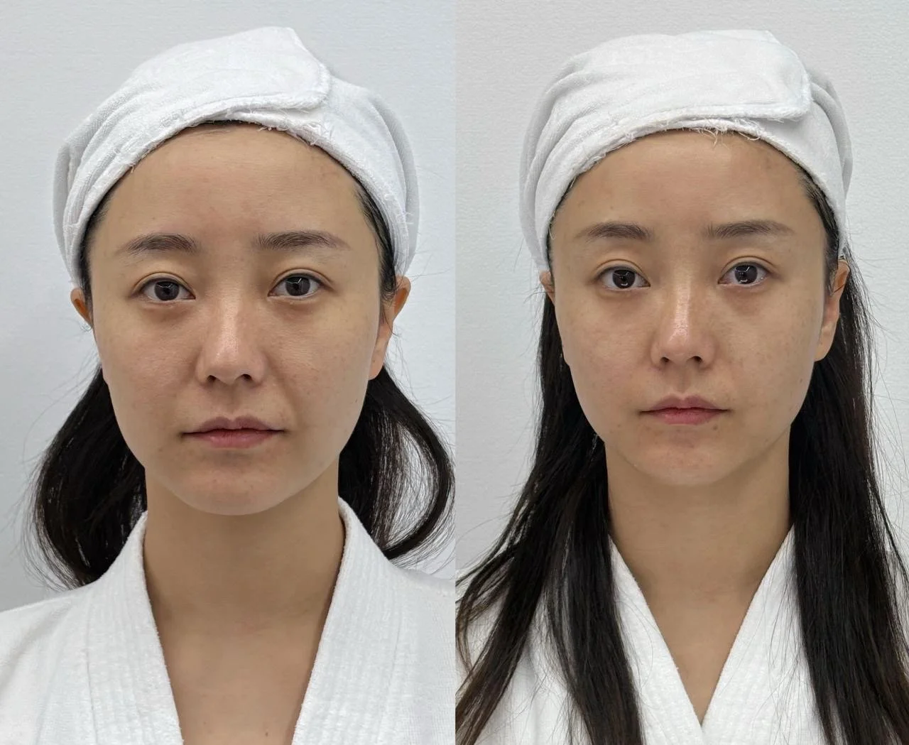 Before & After - Lip Filler