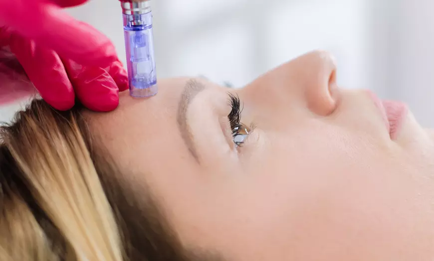 Microneedling treatment at Luminous Aesthetics & Wellness