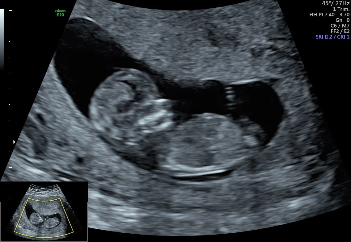 Early pregnancy dating and viability ultrasound