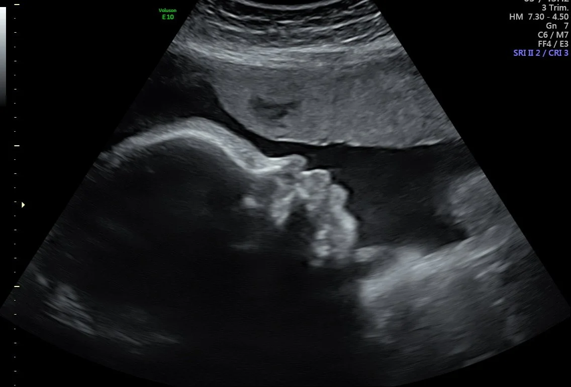 Biophysical profile ultrasound