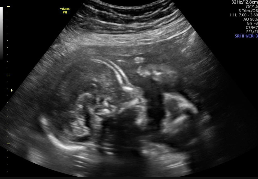 BPP with fetal growth ultrasound