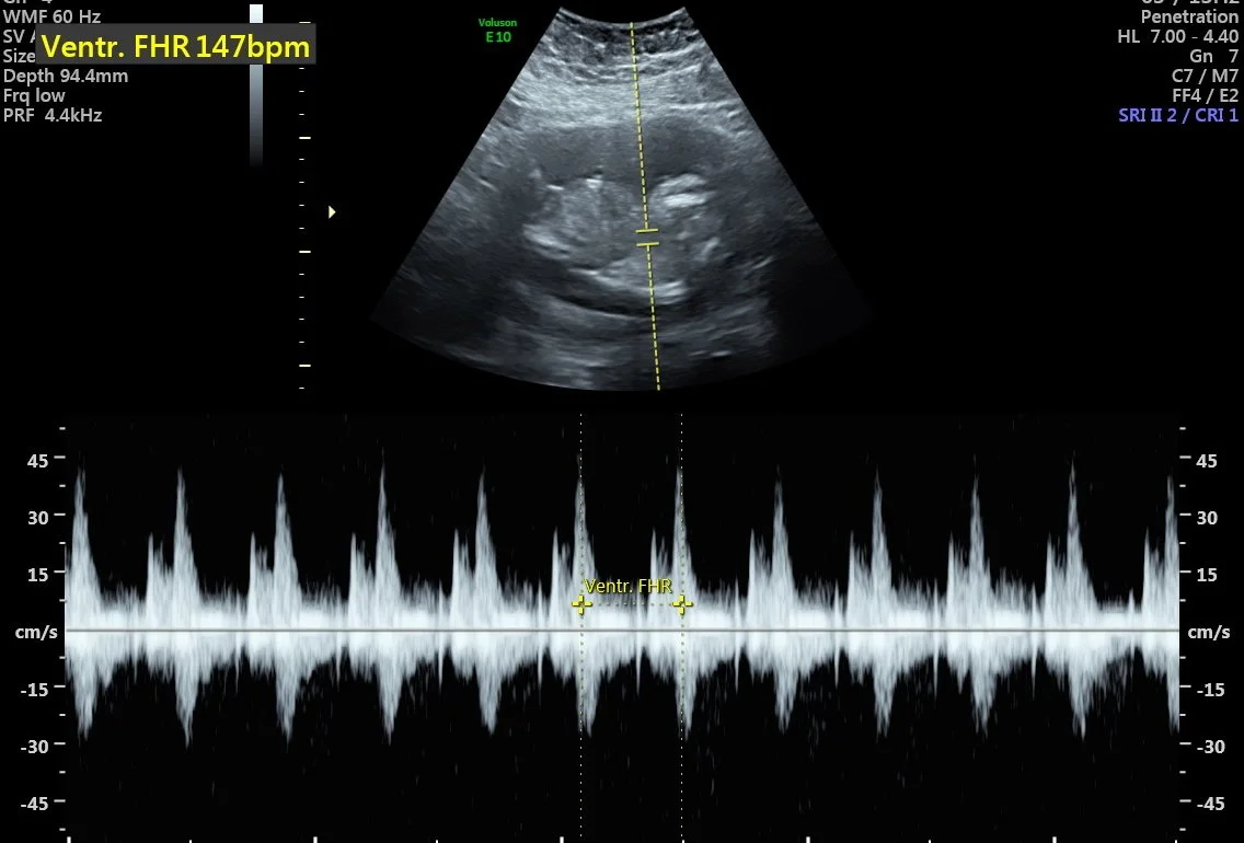 Peace of Mind 2D pregnancy ultrasound