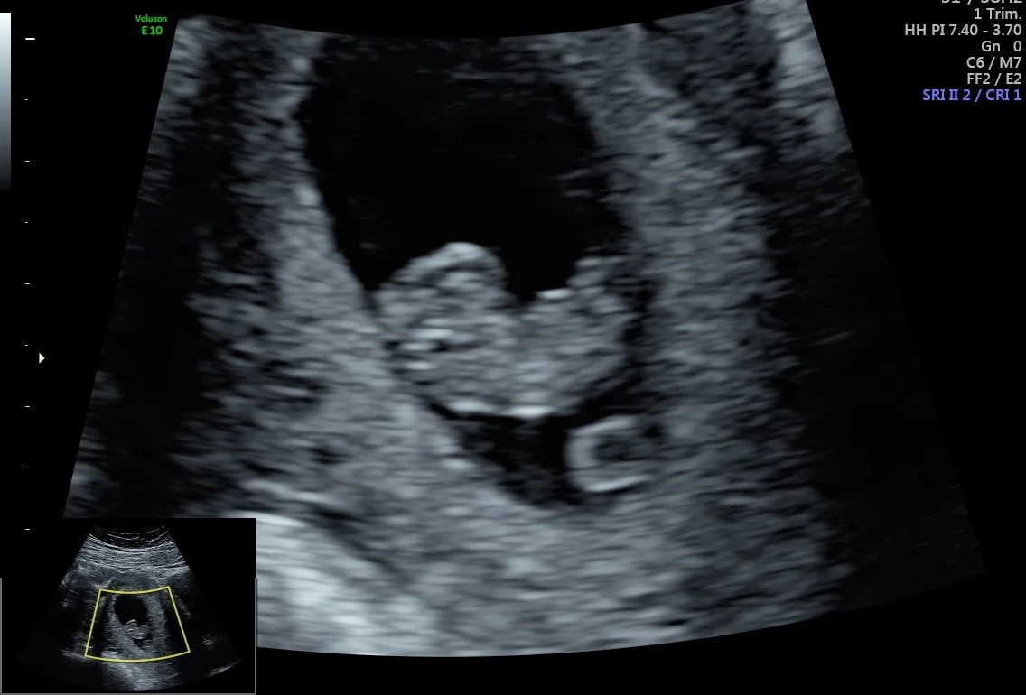 Early pregnancy viability ultrasound at Life in Bloom