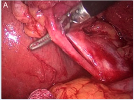 Cystic artery anterior to the cystic duct