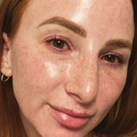 Before Moxi Laser treatment