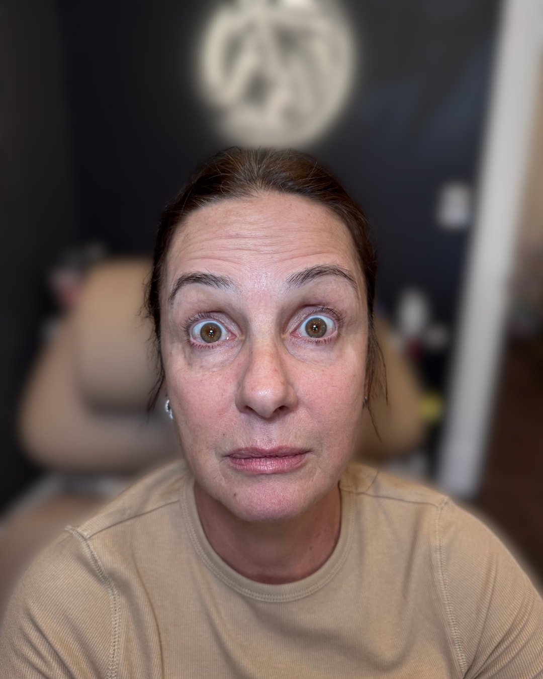 After Botox forehead treatment