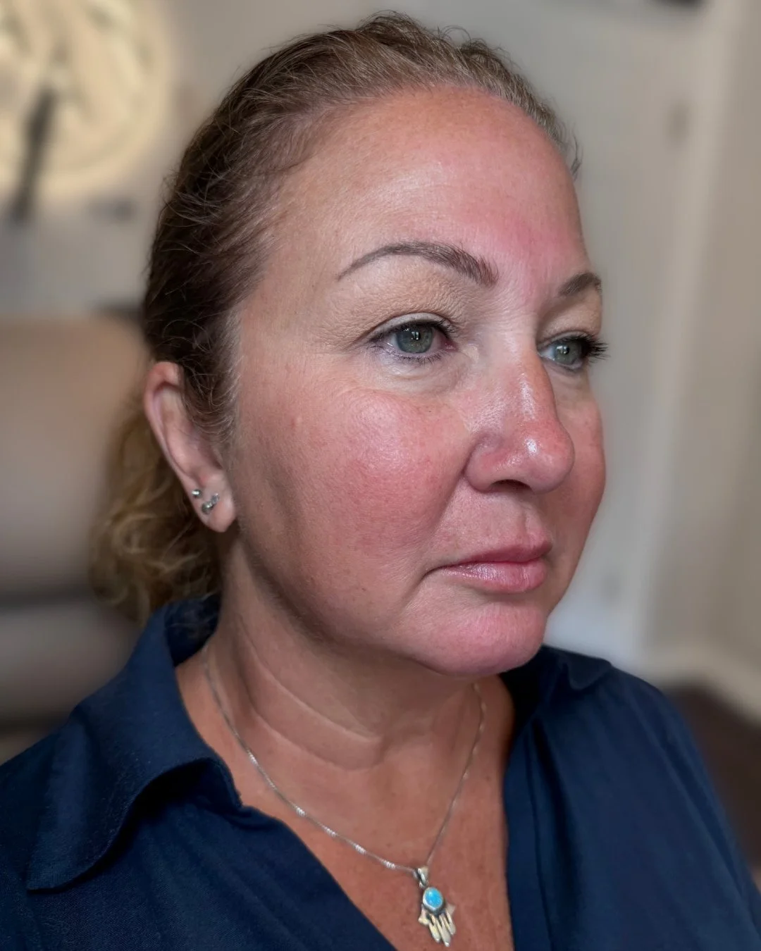 Before lip filler treatment