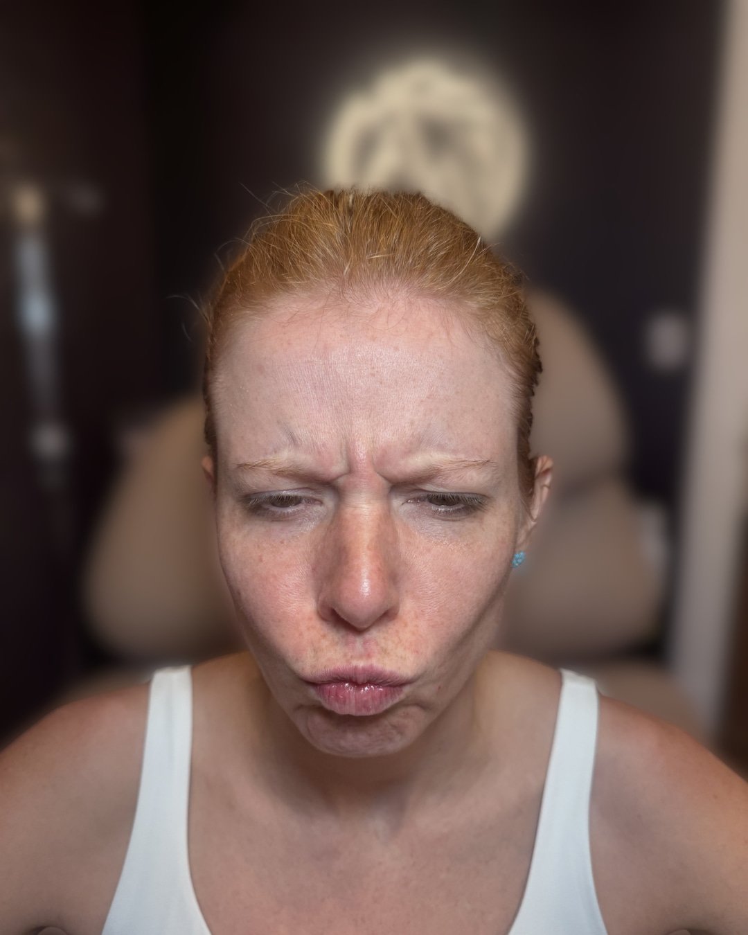 Before Botox treatment