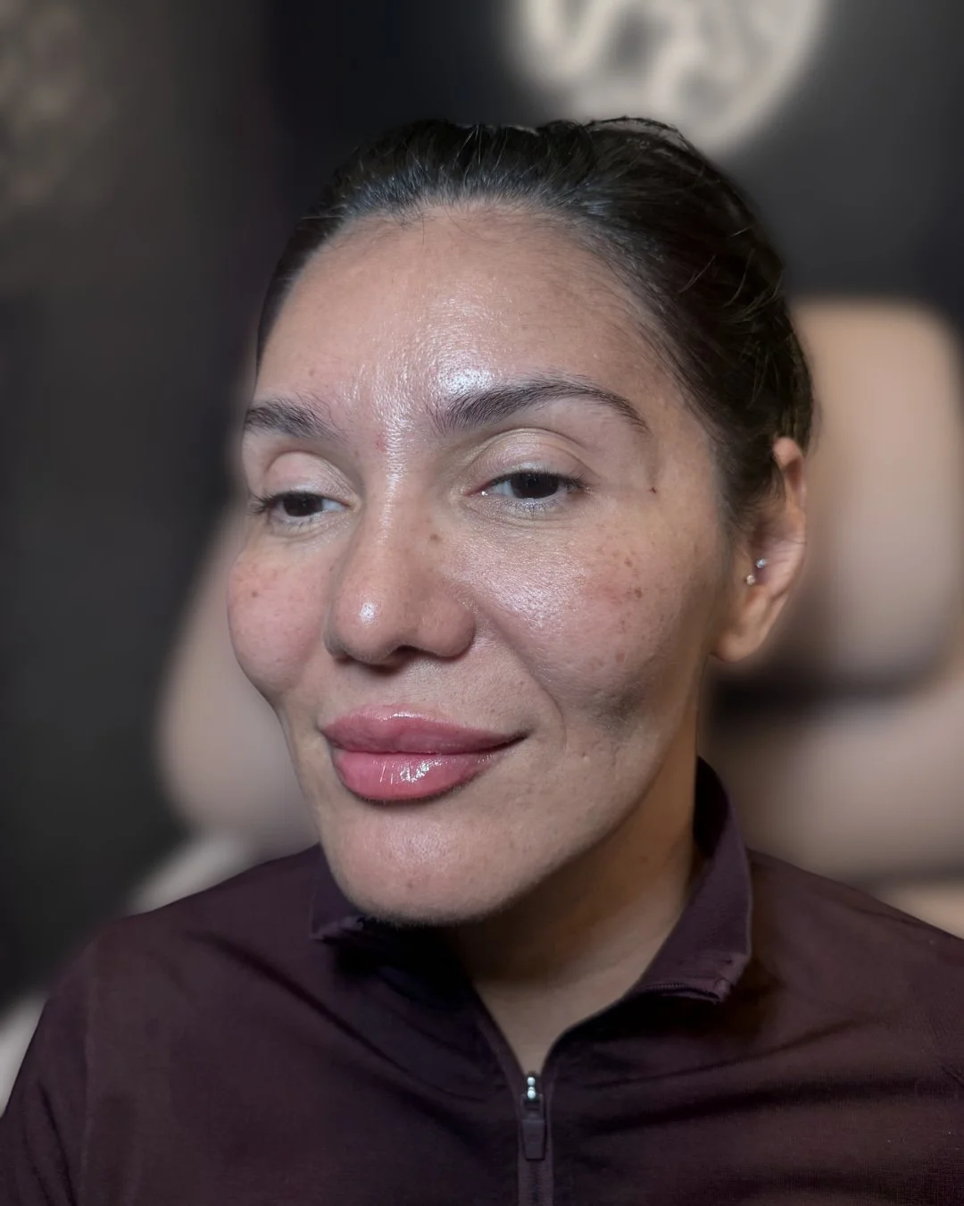 After lip filler treatment