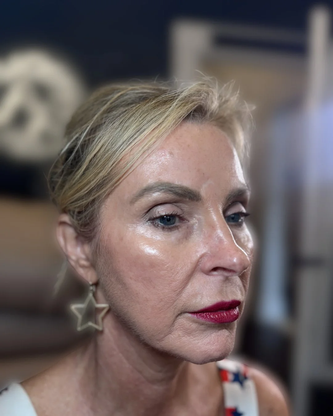 Before cheek and smile line filler treatment