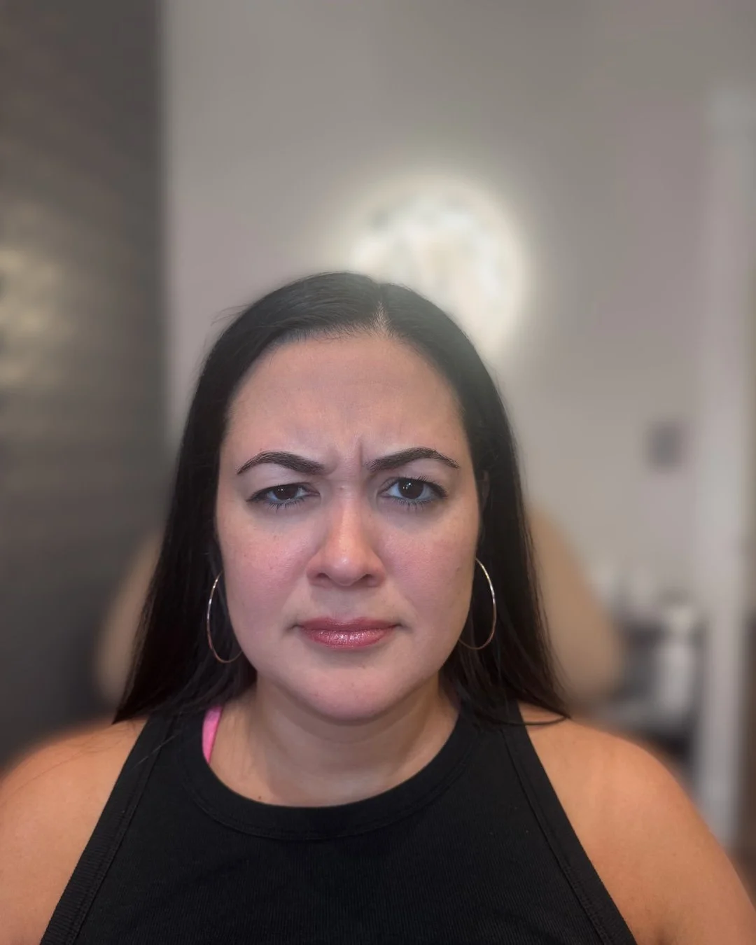 Before Botox treatment