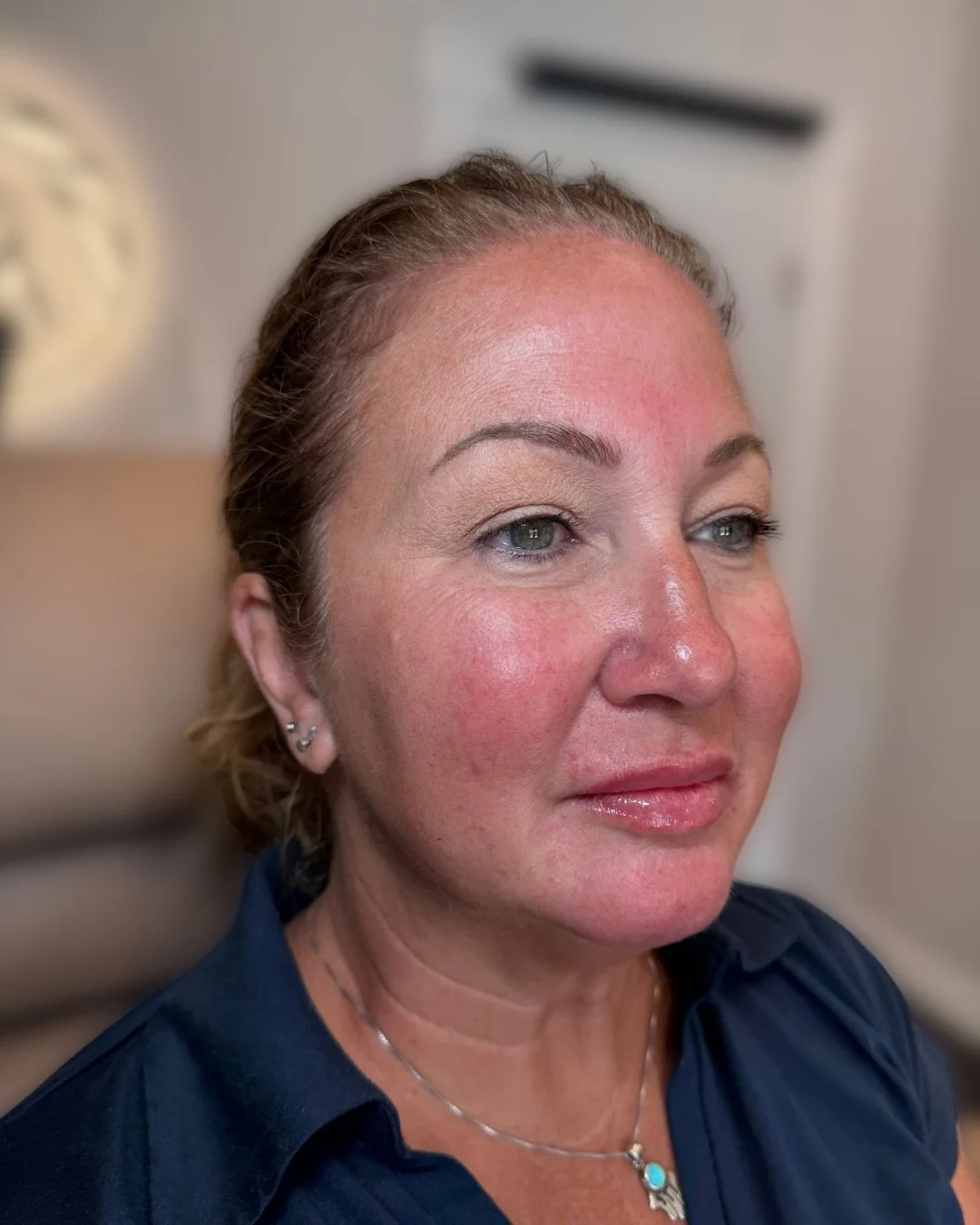 After lip filler treatment
