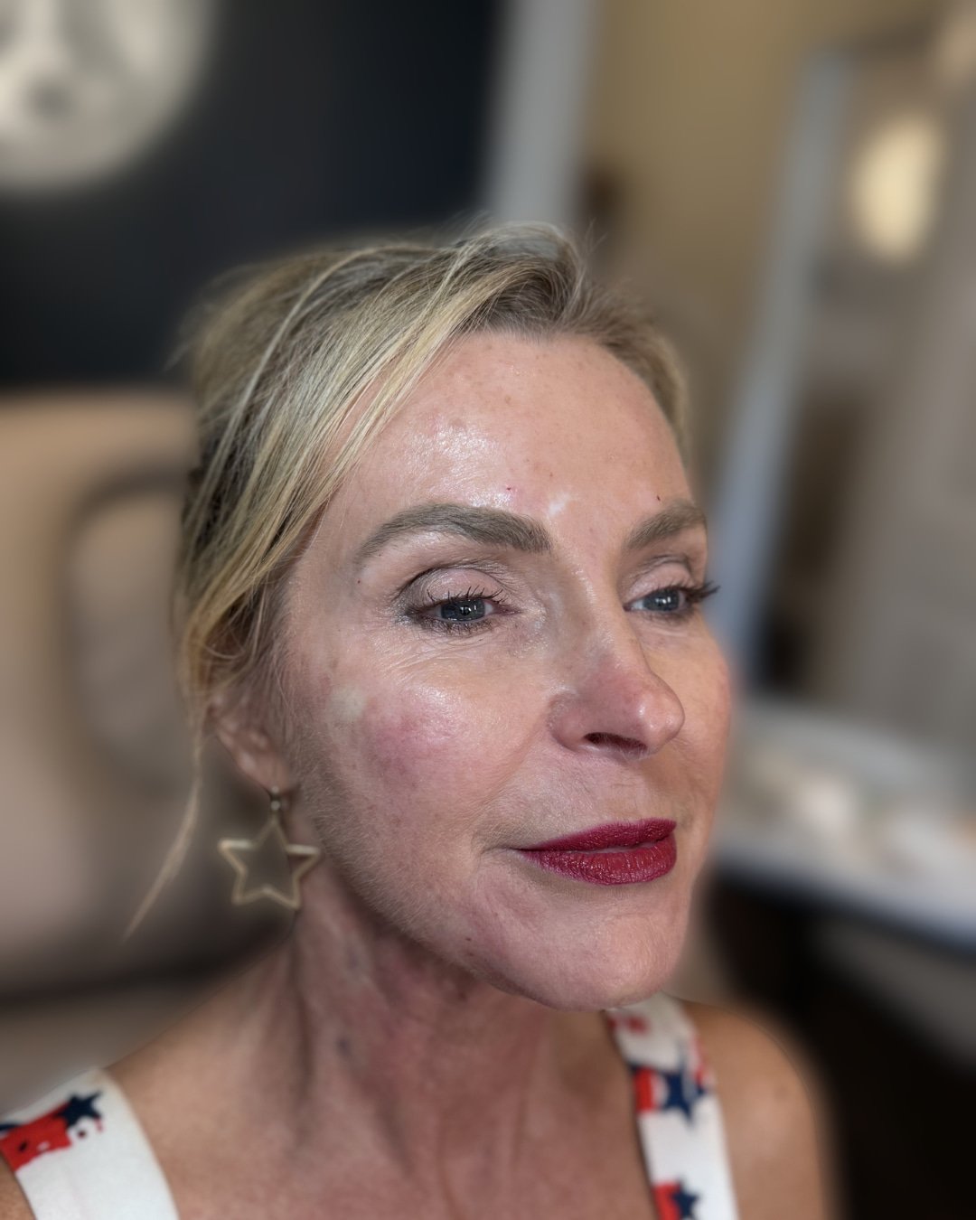 After cheek and smile line filler treatment