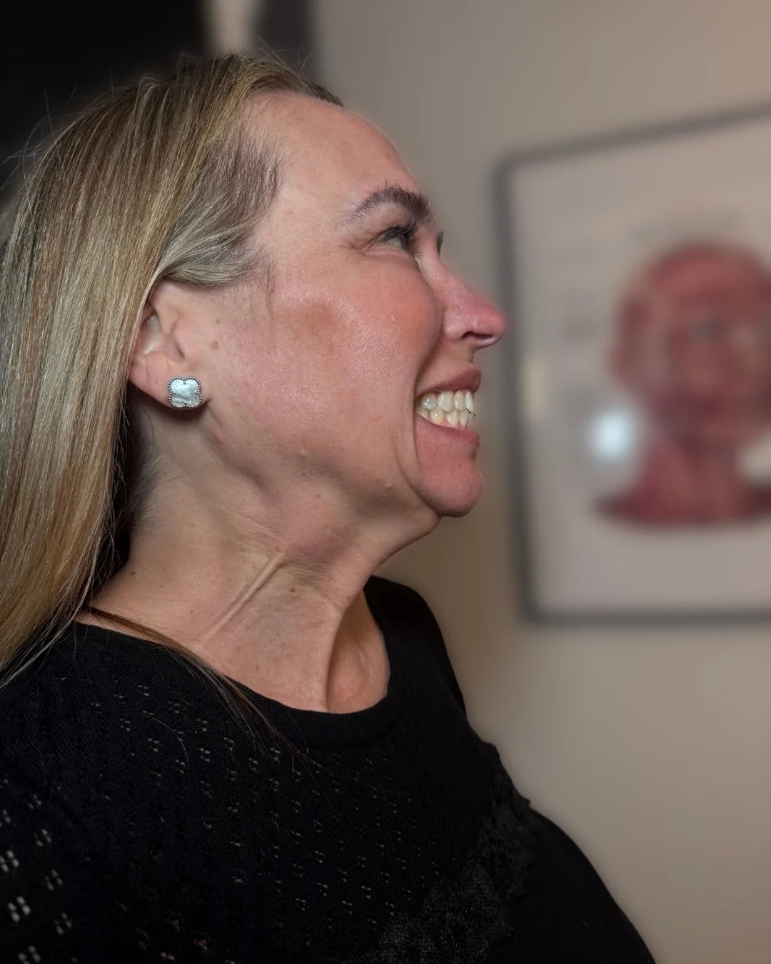 Before Nefertiti neck lift