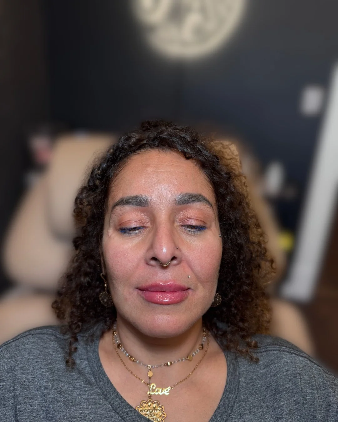 Loretta after smile line and lip filler treatment