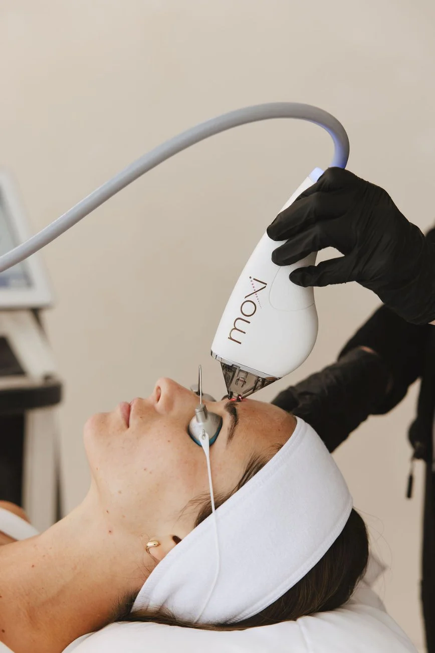 Moxi Laser treating brow area in Tampa FL