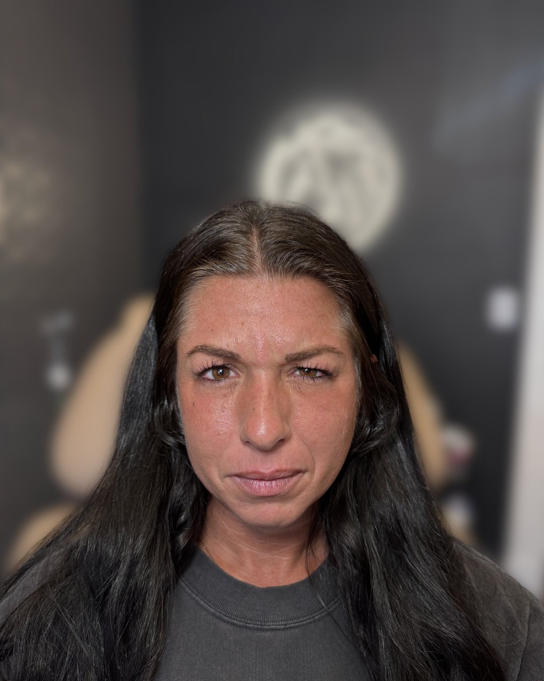 Before Botox treatment