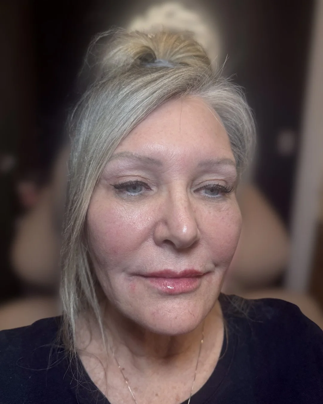 After lip filler treatment