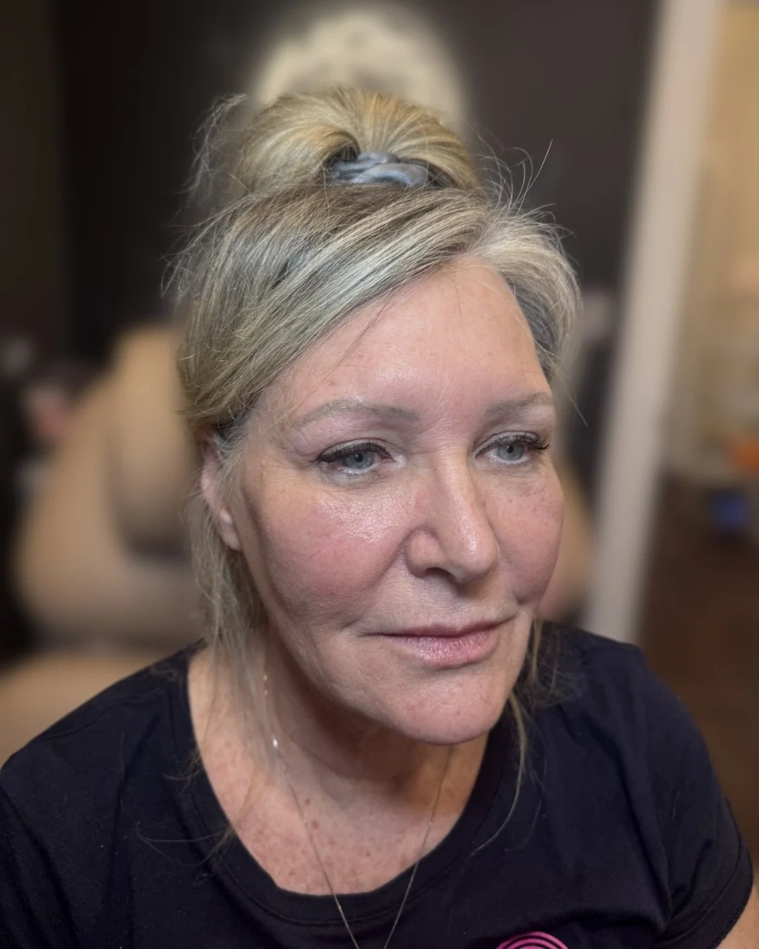 Before lip filler treatment