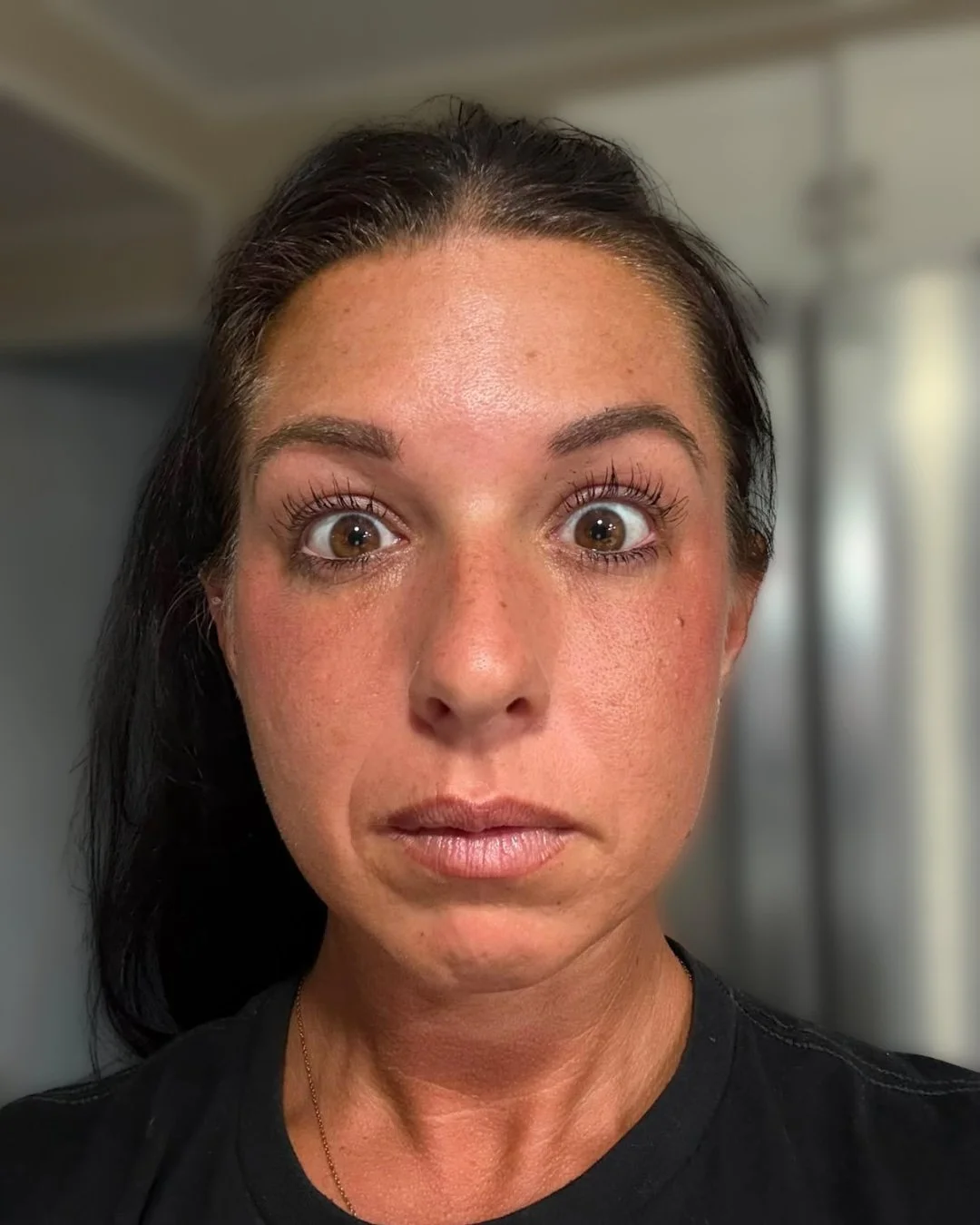 After Botox treatment