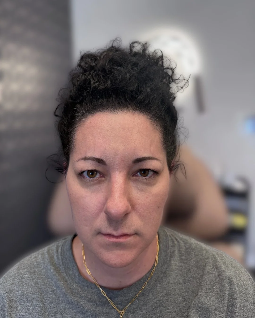 Jamie after Botox forehead treatment