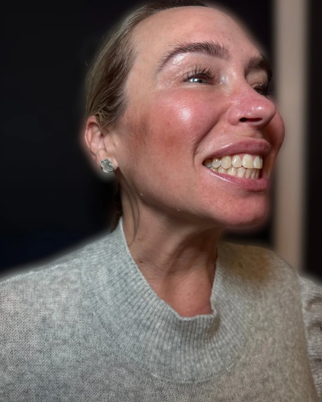 After Nefertiti neck lift