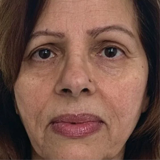 Before BBL HEROic and Moxi treatment