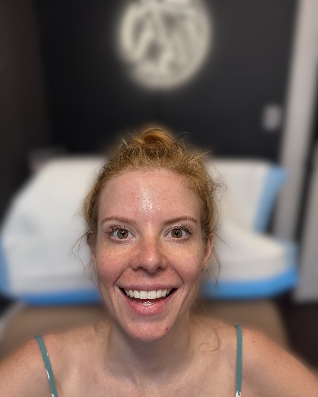 Before Botox treatment