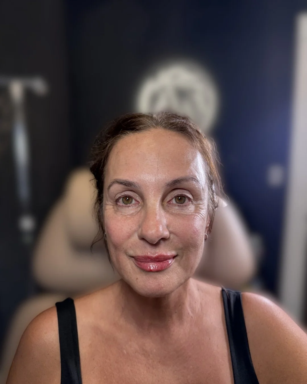 After lip filler treatment