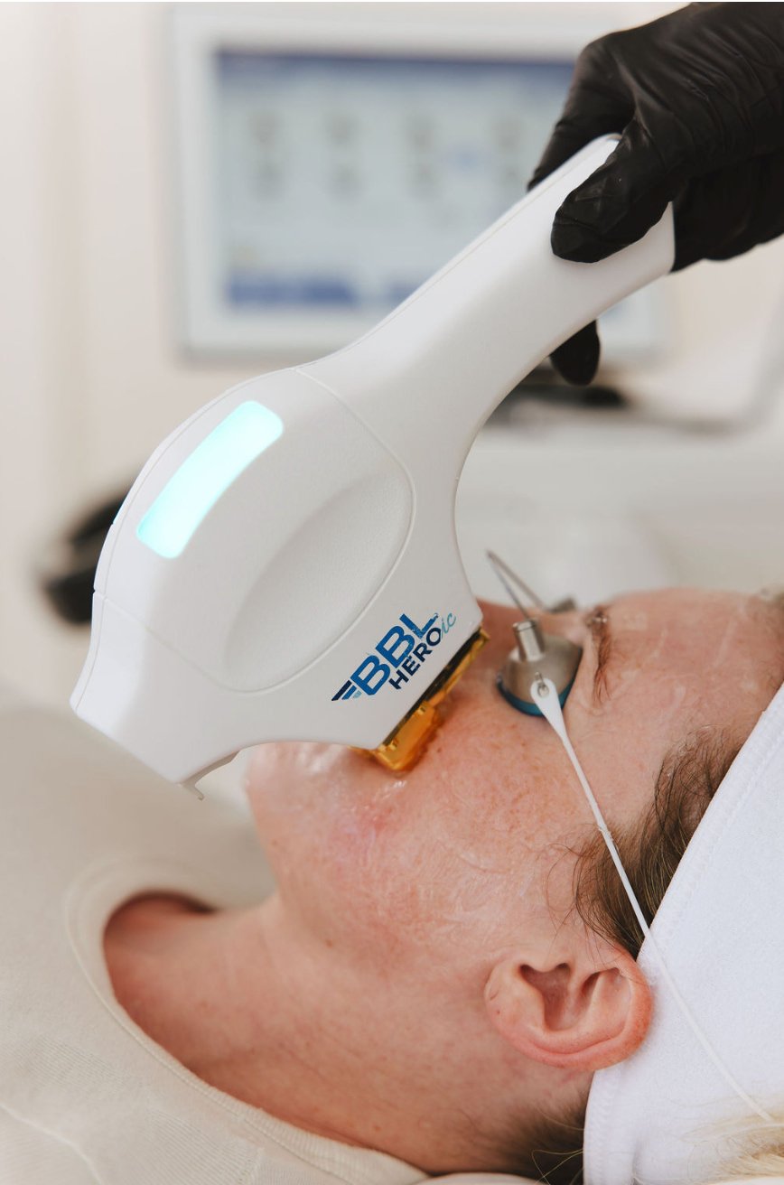 BBL HEROic treating face and cheeks in Tampa FL