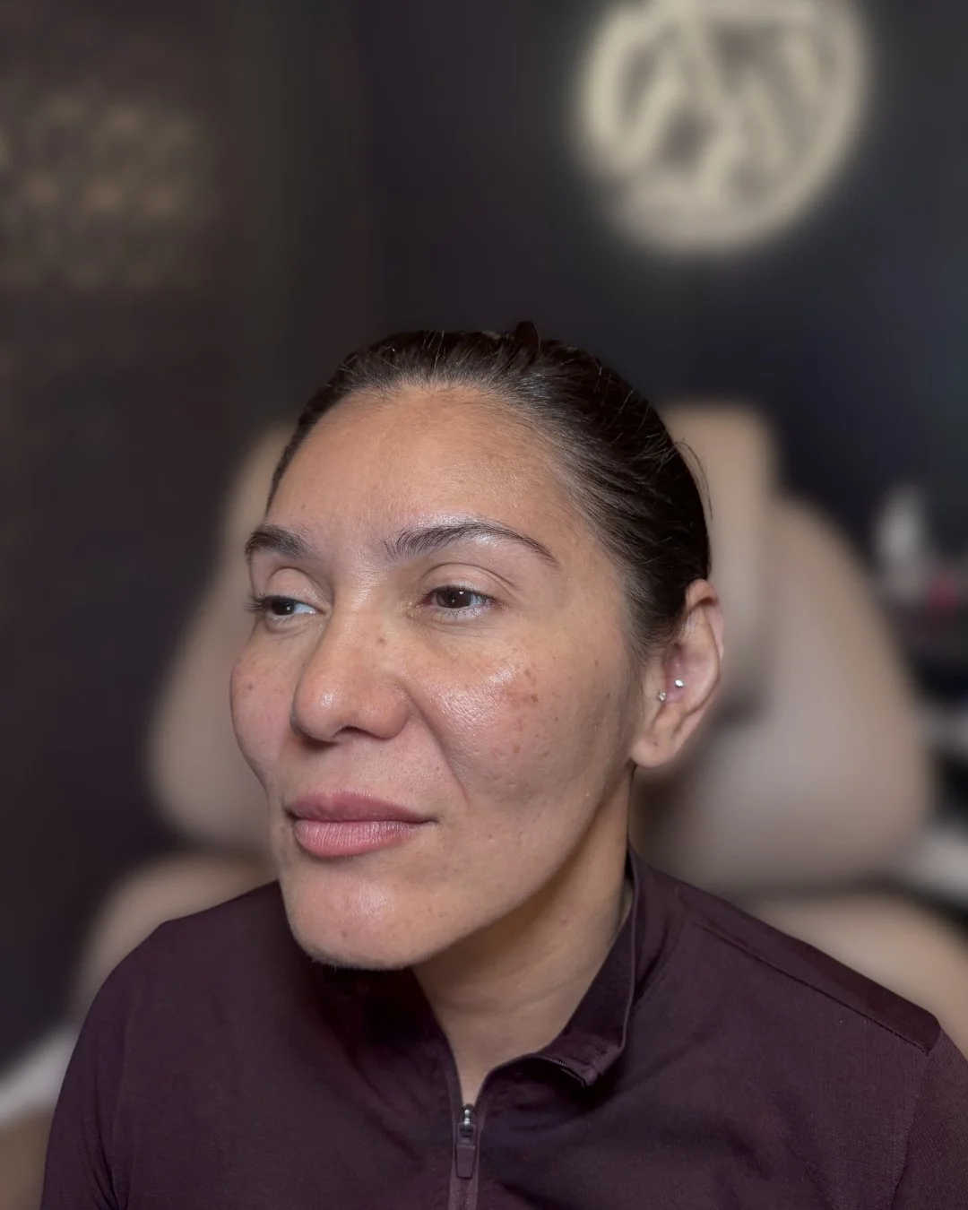 Before lip filler treatment