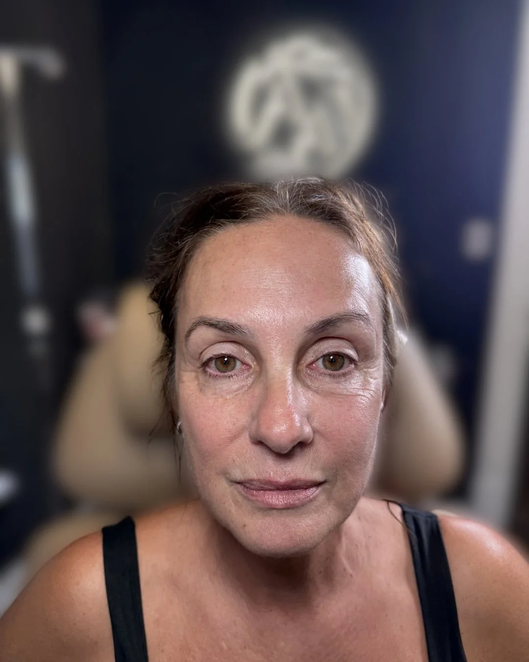 Before lip filler treatment